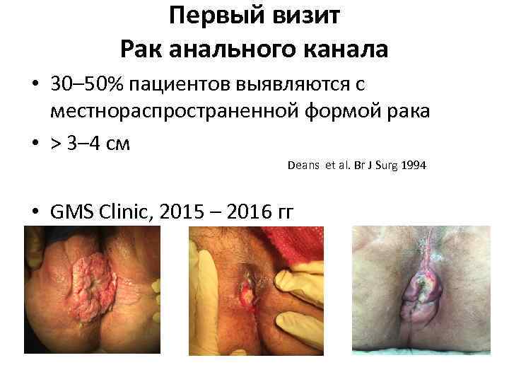 Первый визит Рак анального канала • 30– 50% пациентов выявляются с местнораспространенной формой рака