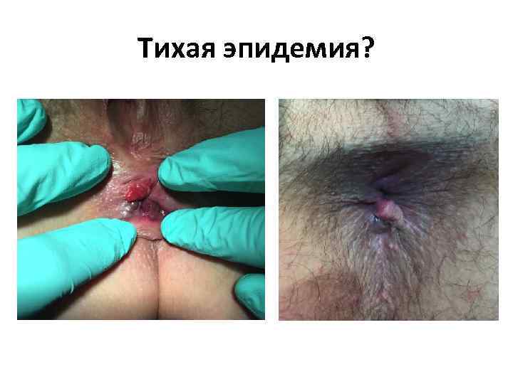 Тихая эпидемия? 