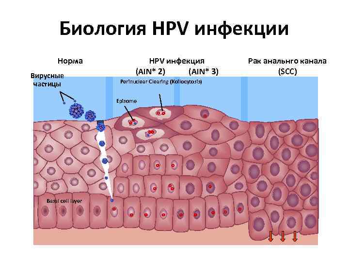 Биология HPV инфекции Норма Вирусные частицы HPV инфекция (AIN* 2) (AIN* 3) Perinuclear Clearing