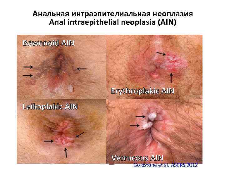 Анальная интраэпителиальная неоплазия Anal intraepithelial neoplasia (AIN) Bowenoid AIN Erythroplakic AIN Leikoplakic AIN Verrucous