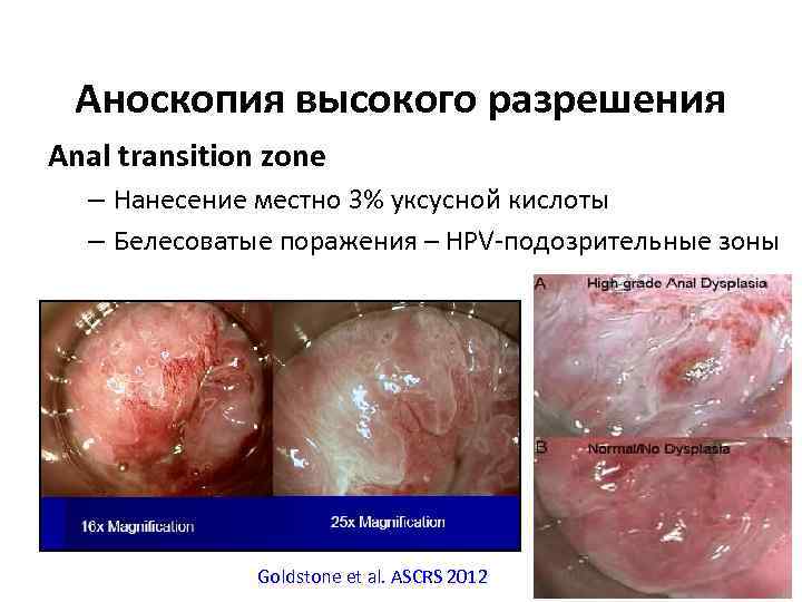 Аноскопия высокого разрешения Anal transition zone – Нанесение местно 3% уксусной кислоты – Белесоватые