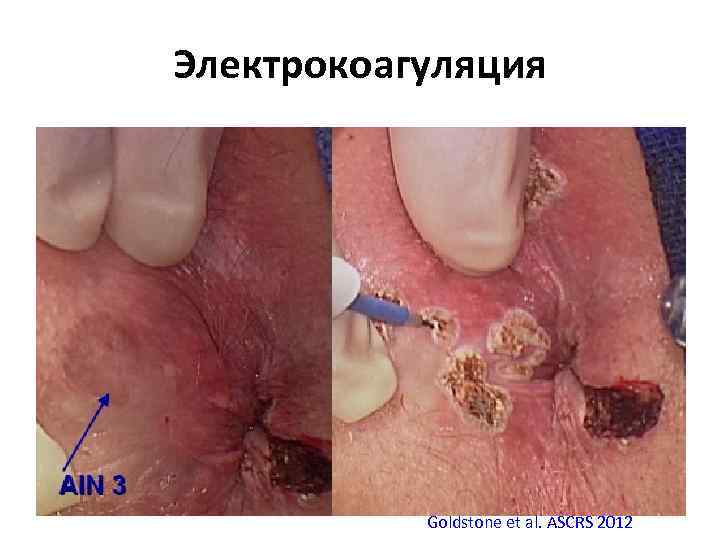 Электрокоагуляция Goldstone et al. ASCRS 2012 