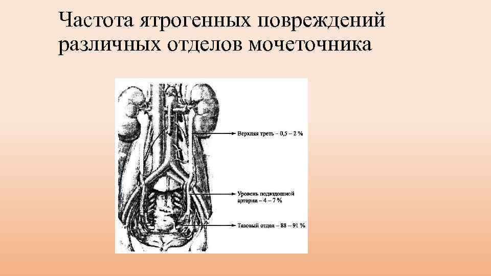 Частота ятрогенных повреждений различных отделов мочеточника 