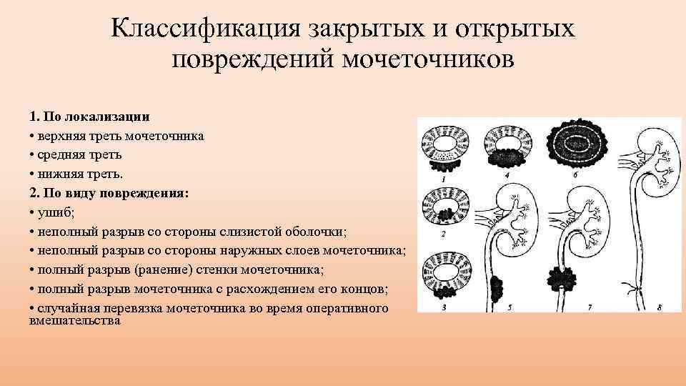 Классификация закрытых и открытых повреждений мочеточников 1. По локализации • верхняя треть мочеточника •