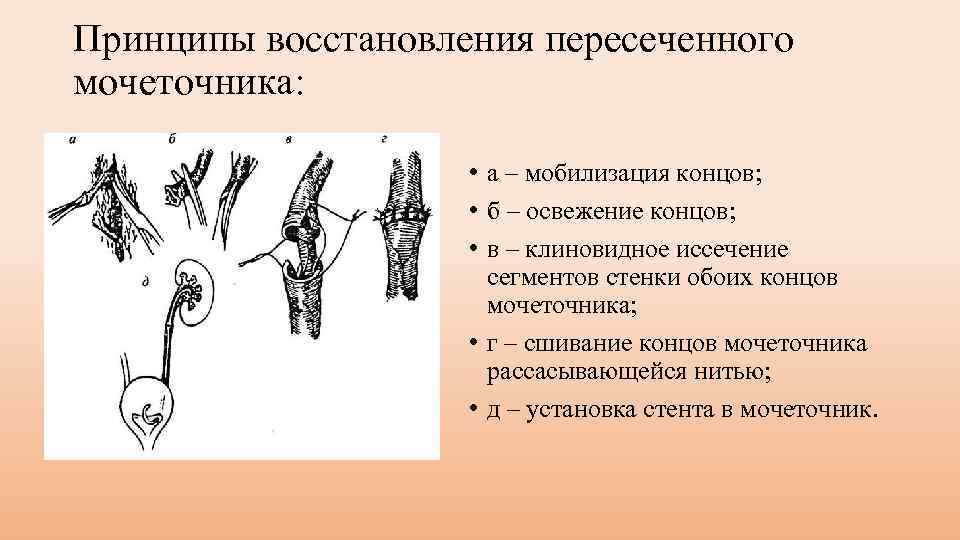 Принципы восстановления пересеченного мочеточника: • а – мобилизация концов; • б – освежение концов;