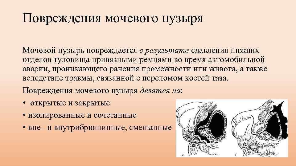 Повреждения мочевого пузыря Мочевой пузырь повреждается в результате сдавления нижних отделов туловища привязными ремнями