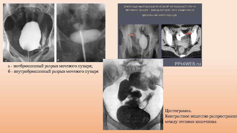 а внебрюшинный разрыв мочевого пузыря; б внутрибрюшинный разрыв мочевого пузыря Цистограмма. Контрастное вещество распространил