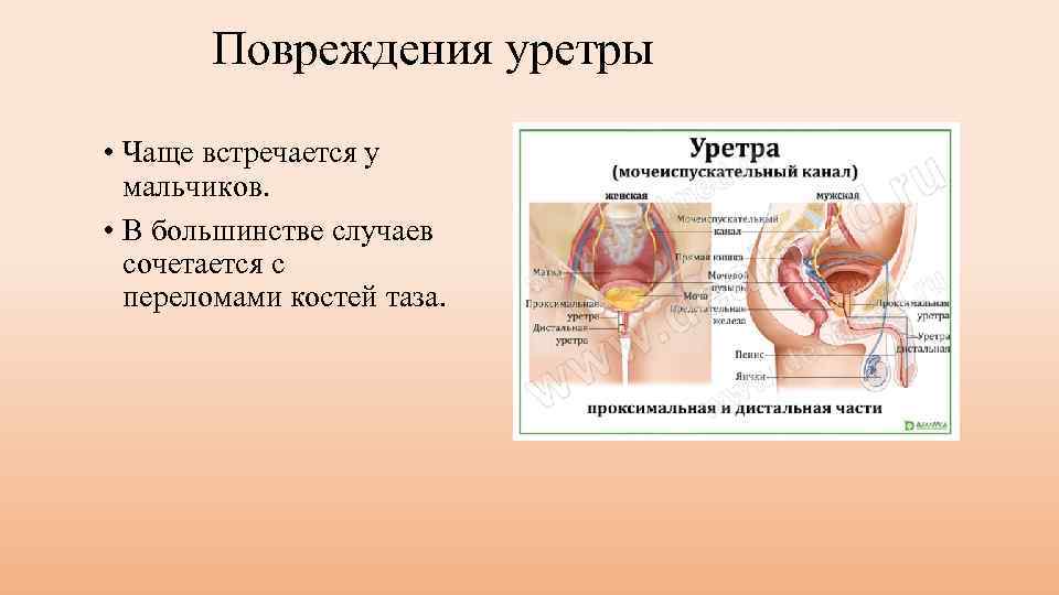 Повреждения уретры • Чаще встречается у мальчиков. • В большинстве случаев сочетается с переломами