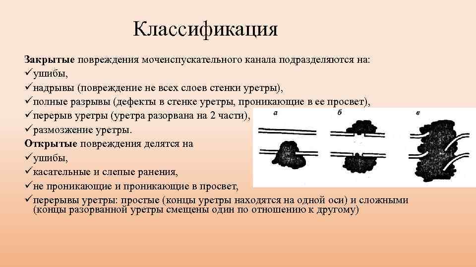 Классификация Закрытые повреждения мочеиспускательного канала подразделяются на: üушибы, üнадрывы (повреждение не всех слоев стенки