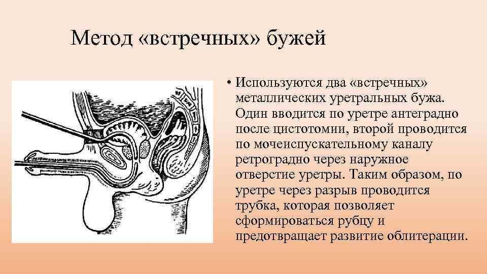 Метод «встречных» бужей • Используются два «встречных» металлических уретральных бужа. Один вводится по уретре