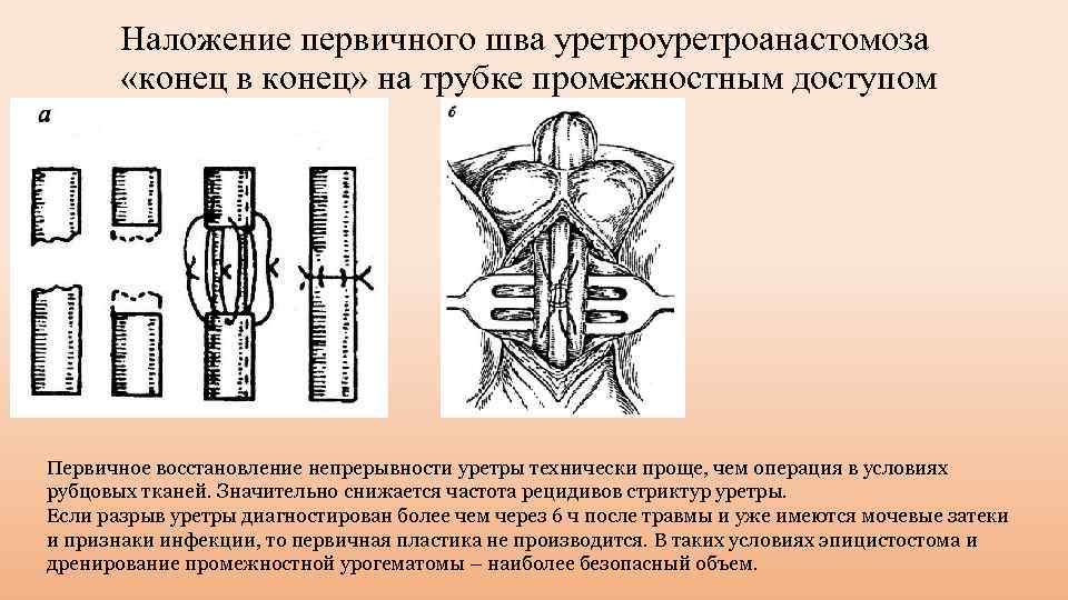 Наложение первичного шва уретроанастомоза «конец в конец» на трубке промежностным доступом Первичное восстановление непрерывности