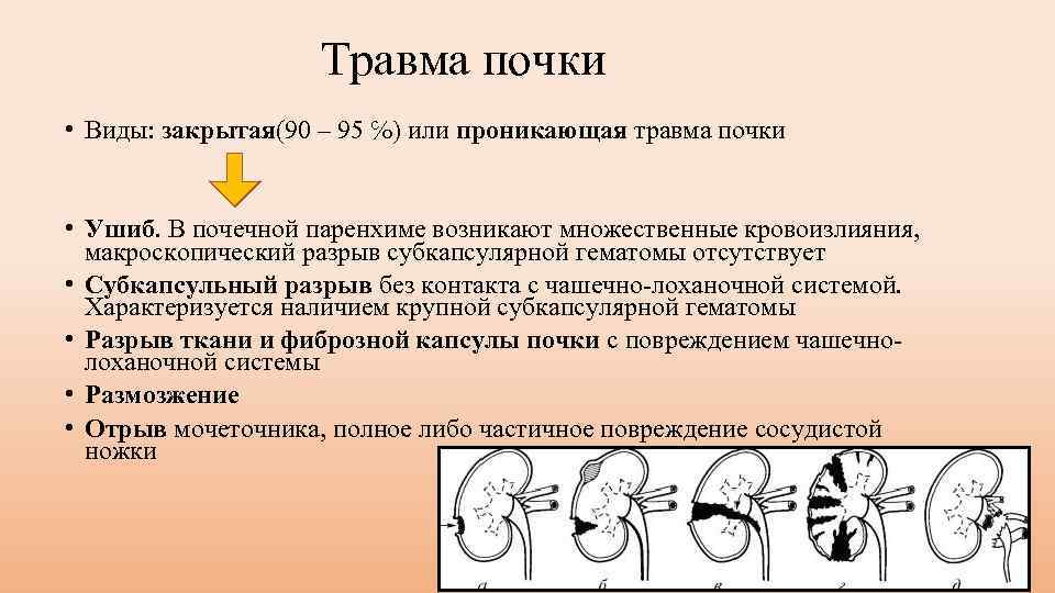 Травма почки • Виды: закрытая(90 – 95 ℅) или проникающая травма почки • Ушиб.