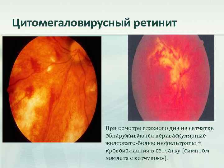 Цитомегаловирусный ретинит При осмотре глазного дна на сетчатке обнаруживаются периваскулярные желтовато-белые инфильтраты ± кровоизлияния