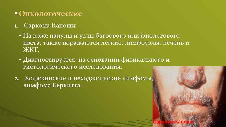 § Онкологические 1. Саркома Капоши • На коже папулы и узлы багрового или фиолетового