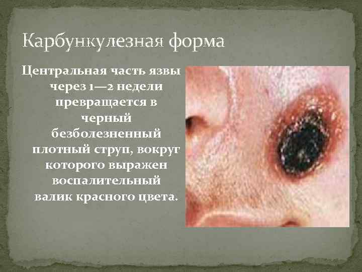 Карбункулезная форма Центральная часть язвы через 1— 2 недели превращается в черный безболезненный плотный