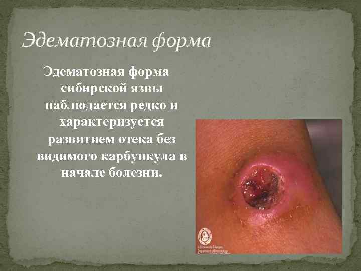Эдематозная форма сибирской язвы наблюдается редко и характеризуется развитием отека без видимого карбункула в