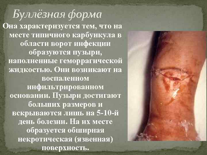 Буллёзная форма Она характеризуется тем, что на месте типичного карбункула в области ворот инфекции