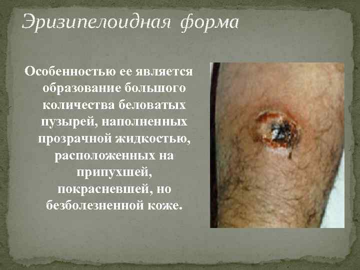 Эризипелоидная форма Особенностью ее является образование большого количества беловатых пузырей, наполненных прозрачной жидкостью, расположенных