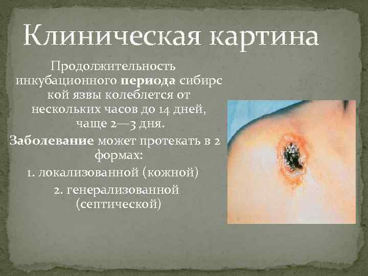 Клиническая картина Продолжительность инкубационного периода сибирс кой язвы колеблется от нескольких часов до 14