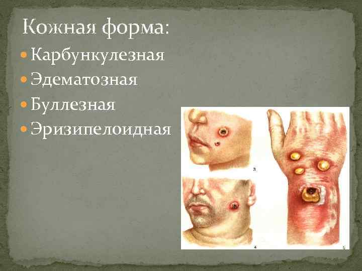 Кожная форма: Карбункулезная Эдематозная Буллезная Эризипелоидная 