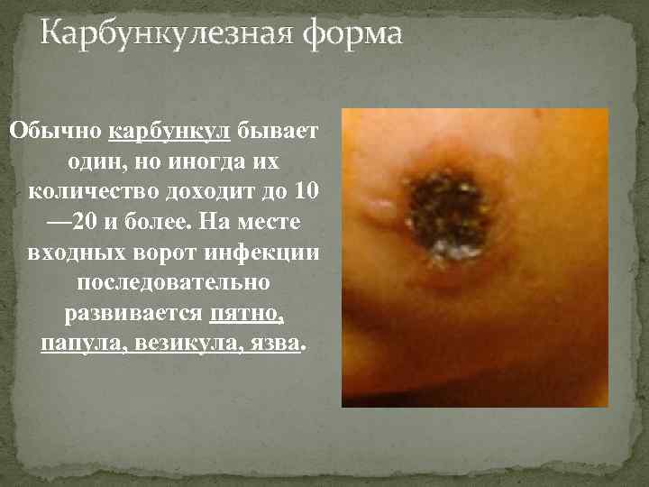 Карбункулезная форма Обычно карбункул бывает один, но иногда их количество доходит до 10 —