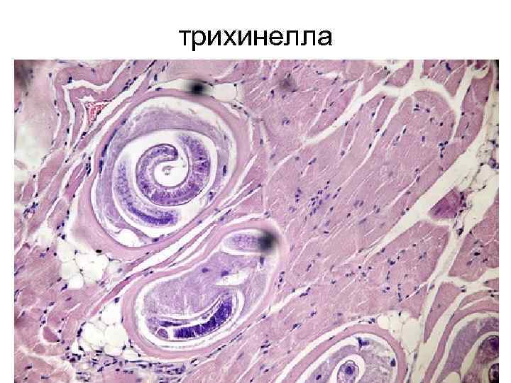 трихинелла 
