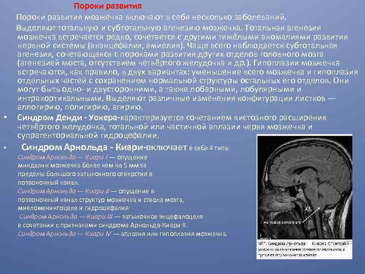  Пороки развития мозжечка включают в себя несколько заболеваний. Выделяют тотальную и субтотальную агенезию