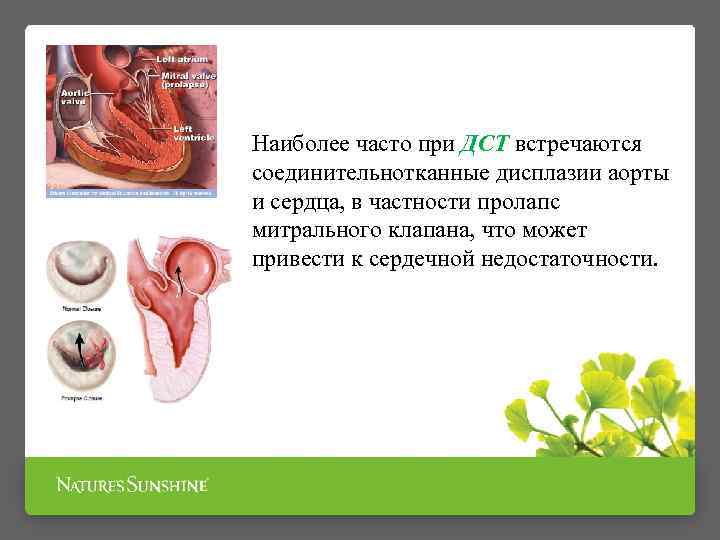 Наиболее часто при ДСТ встречаются соединительнотканные дисплазии аорты и сердца, в частности пролапс митрального