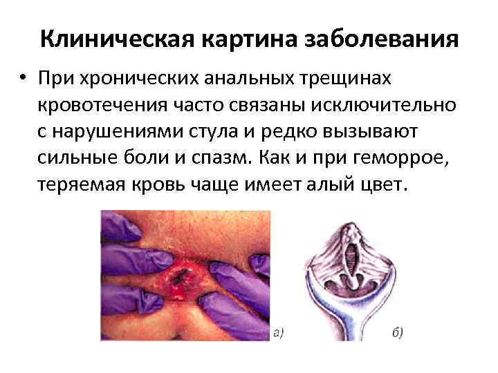 Клиническая картина заболевания • При хронических анальных трещинах кровотечения часто связаны исключительно с нарушениями