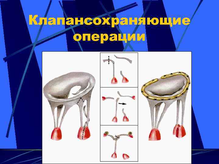 Клапансохраняющие операции 