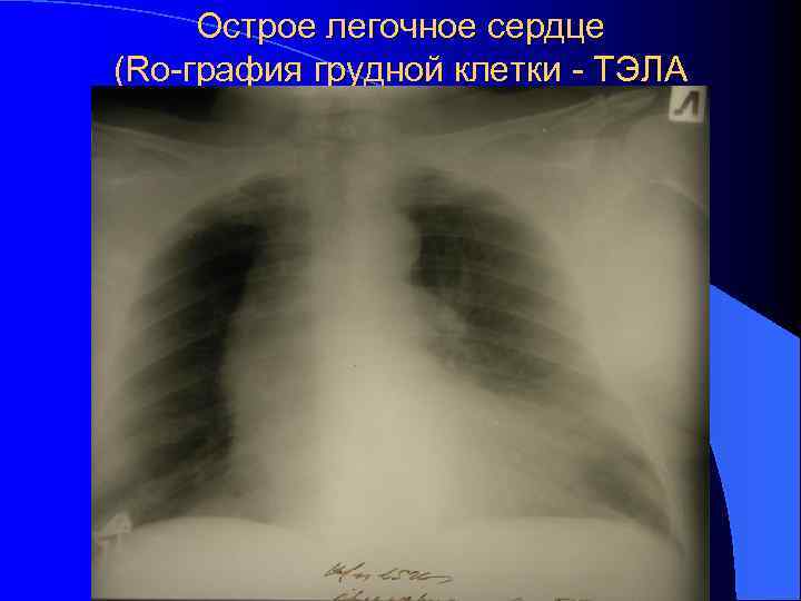 Острое легочное сердце (Rо-графия грудной клетки - ТЭЛА 