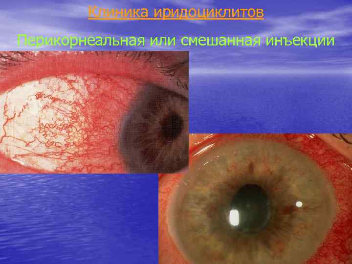 Клиника иридоциклитов Перикорнеальная или смешанная инъекции 