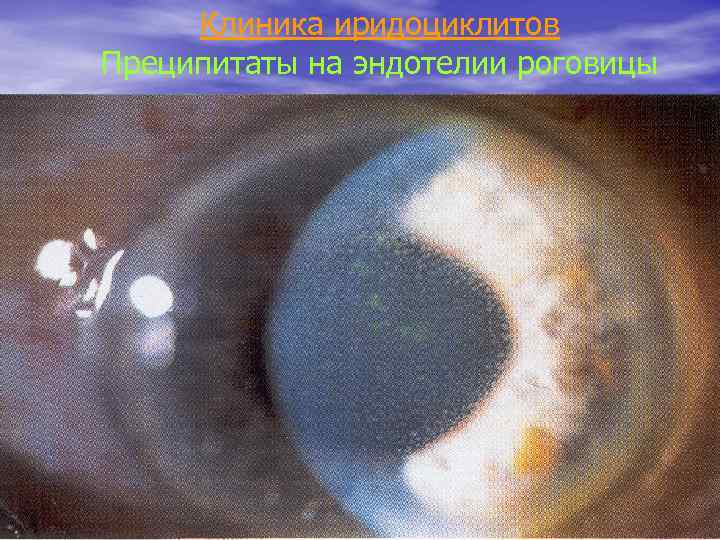 Клиника иридоциклитов Преципитаты на эндотелии роговицы 