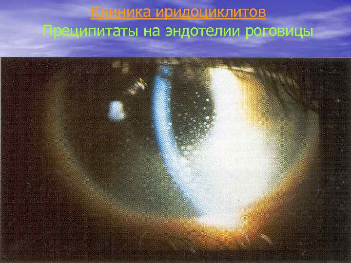 Клиника иридоциклитов Преципитаты на эндотелии роговицы 