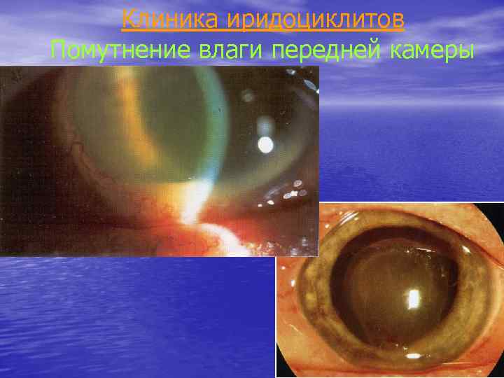 Клиника иридоциклитов Помутнение влаги передней камеры 