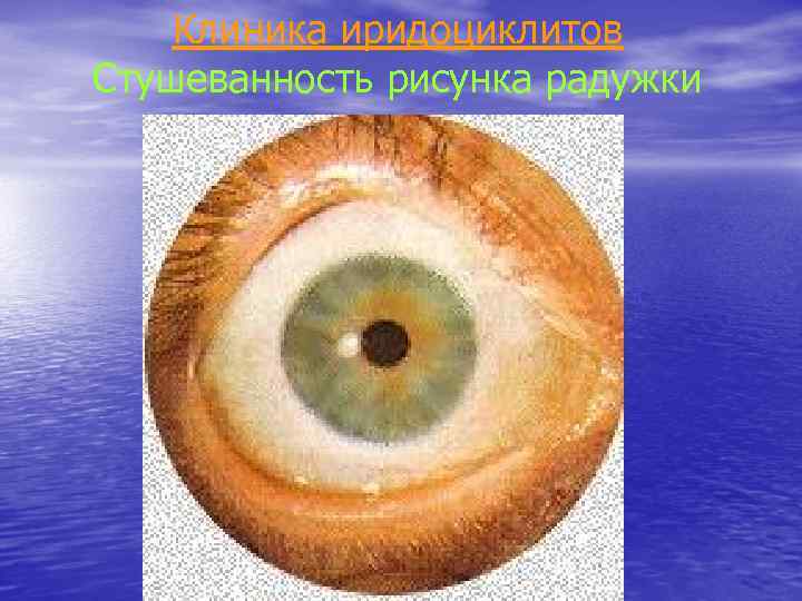 Клиника иридоциклитов Стушеванность рисунка радужки 