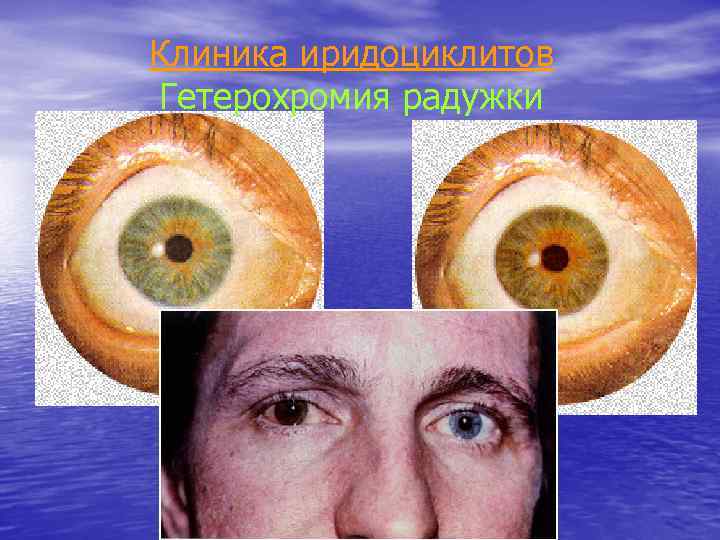 Клиника иридоциклитов Гетерохромия радужки 