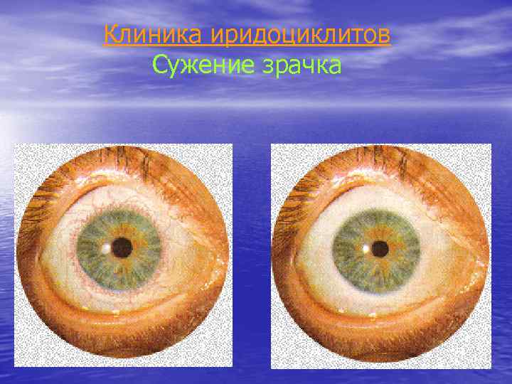 Клиника иридоциклитов Сужение зрачка 