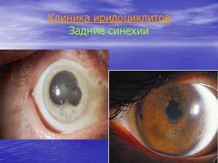 Клиника иридоциклитов Задние синехии 