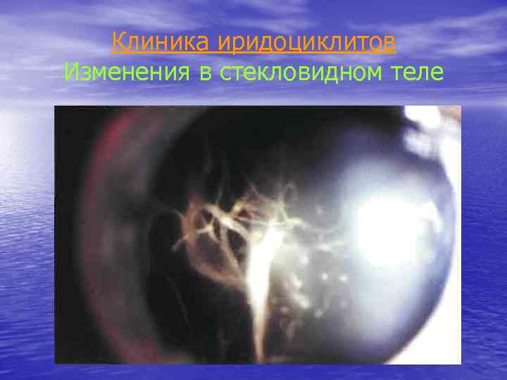 Клиника иридоциклитов Изменения в стекловидном теле 