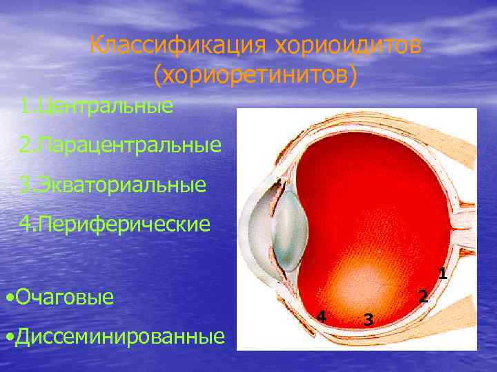 Классификация хориоидитов (хориоретинитов) 1. Центральные 2. Парацентральные 3. Экваториальные 4. Периферические • Очаговые •