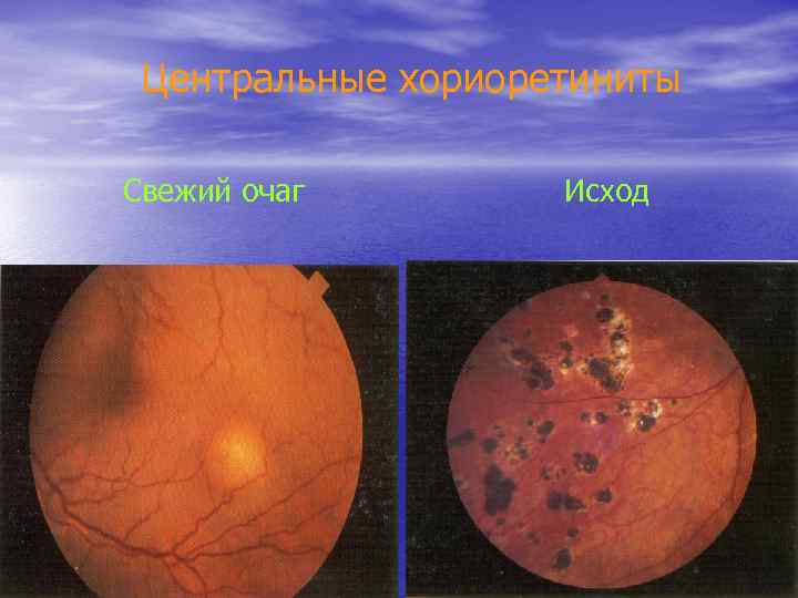 Центральные хориоретиниты Свежий очаг Исход 