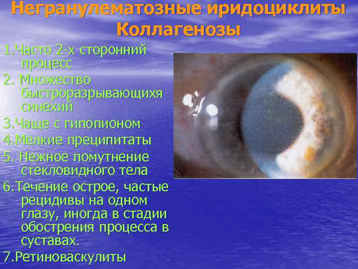 Негранулематозные иридоциклиты Коллагенозы 1. Часто 2 -х сторонний процесс 2. Множество быстроразрывающихя синехий 3.