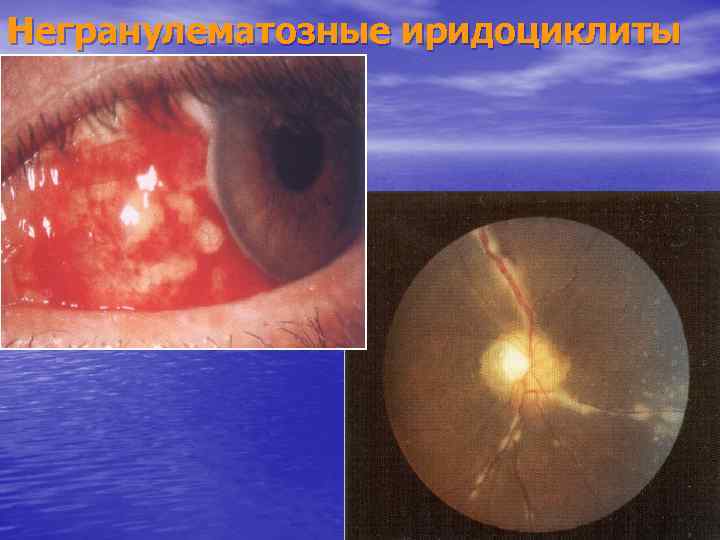 Негранулематозные иридоциклиты 