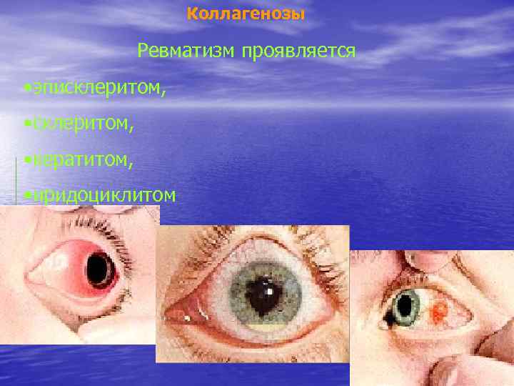 Коллагенозы Ревматизм проявляется • эписклеритом, • кератитом, • иридоциклитом 