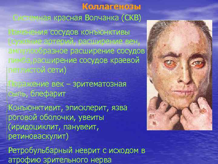 Коллагенозы Системная красная Волчанка (СКВ) Изменения сосудов конъюнктивы (сужение артерий, расширение вен, ампулообразное расширение