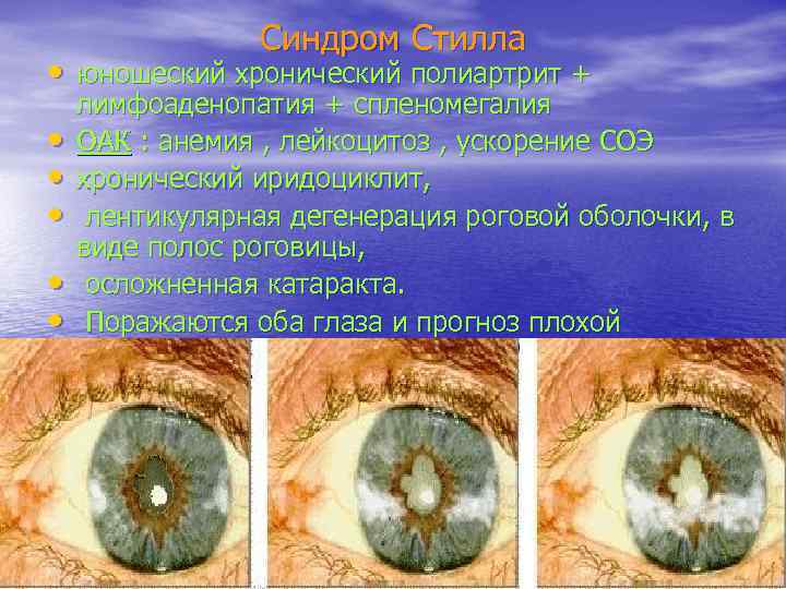 Синдром Стилла • юношеский хронический полиартрит + • • • лимфоаденопатия + спленомегалия ОАК