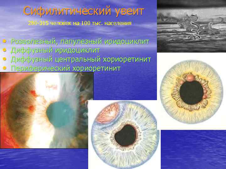 Сифилитический увеит 280 -315 человек на 100 тыс. населения • • Розеолезный, папулезный иридоциклит