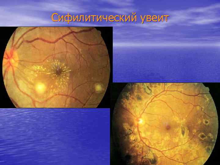 Сифилитический увеит 