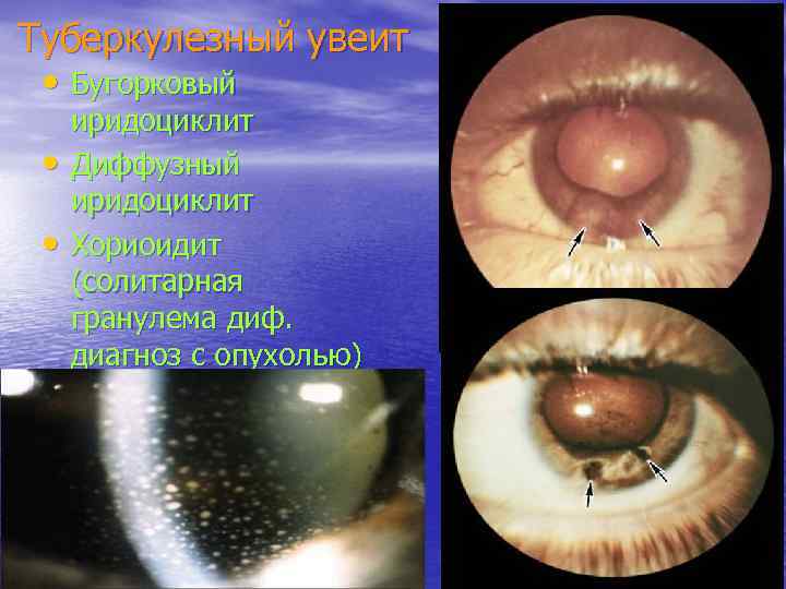 Туберкулезный увеит • Бугорковый • • иридоциклит Диффузный иридоциклит Хориоидит (солитарная гранулема диф. диагноз
